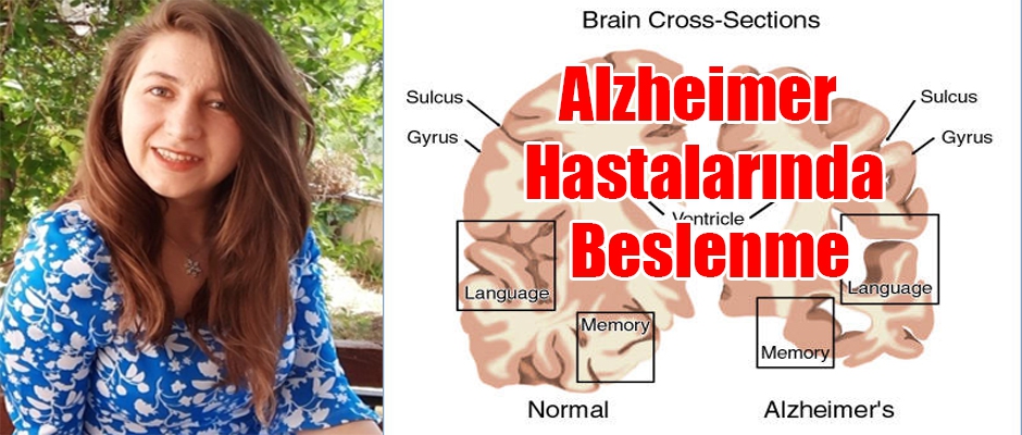 Alzheimer Hastalarında Beslenme